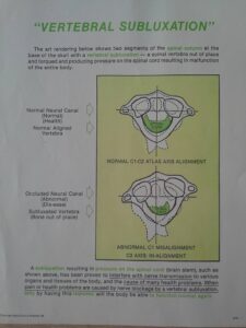 luxation des cervicales